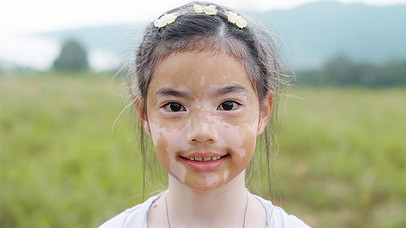 Taux de Repigmentation : Les Adolescents en Tête des Traitements Médicamenteux !