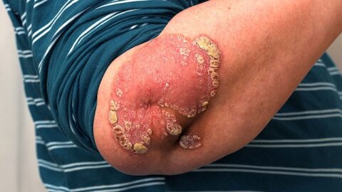 Psoriasis : Le Rôle Étonnant des Cellules Mémoire Résidentes dans les Tissus