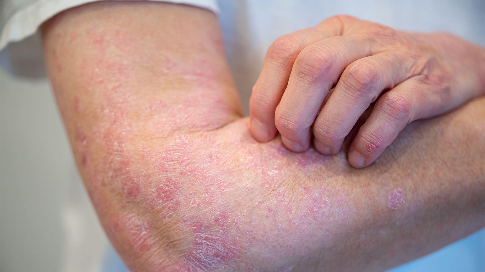 Contrôle du psoriasis à long terme grâce à un intervalle de dosage prolongé de Guselkumab