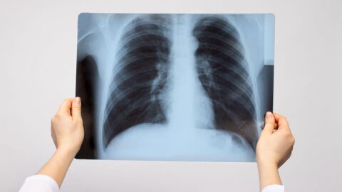 Des diagnostics de pneumonie souvent erronés ?