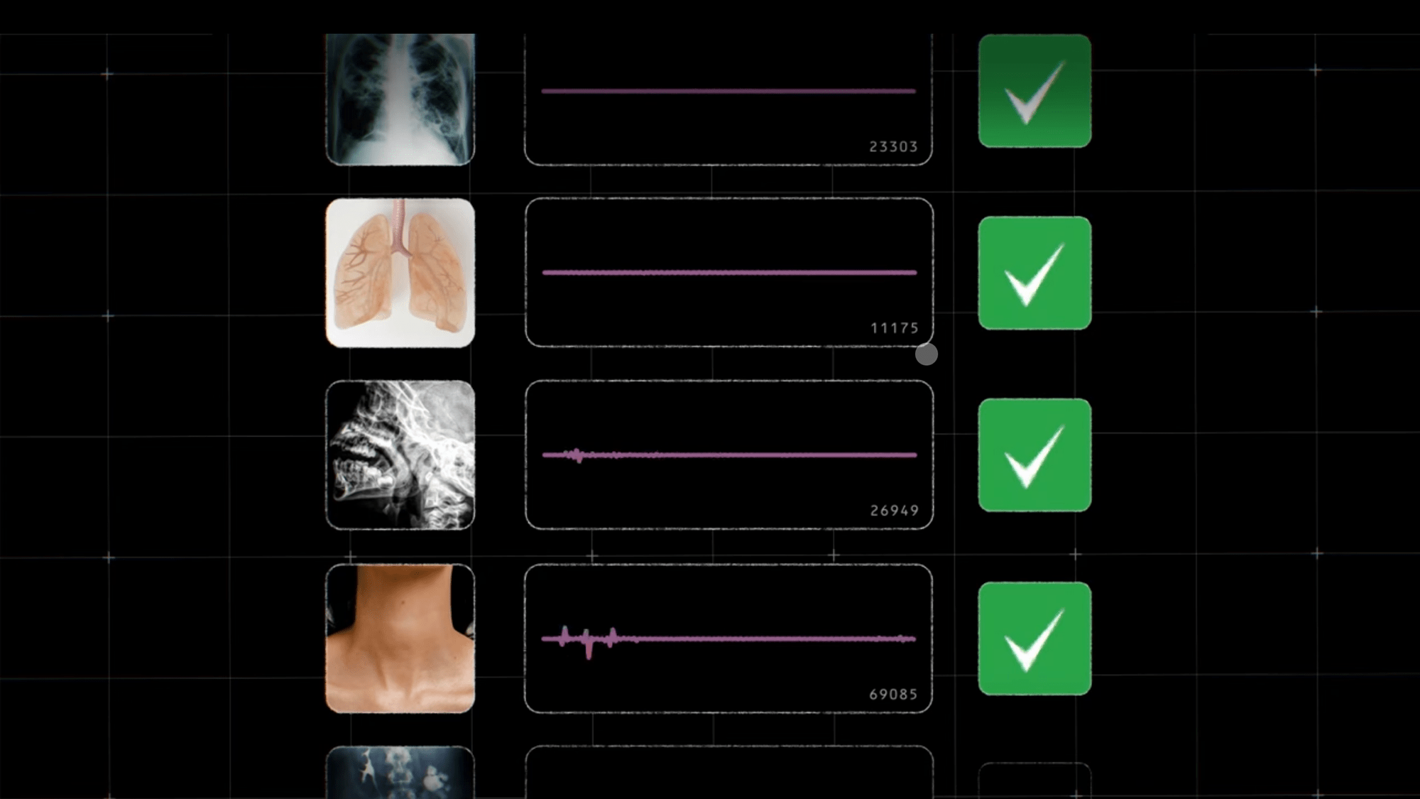 AI can spot tuberculosis early by listening to your cough