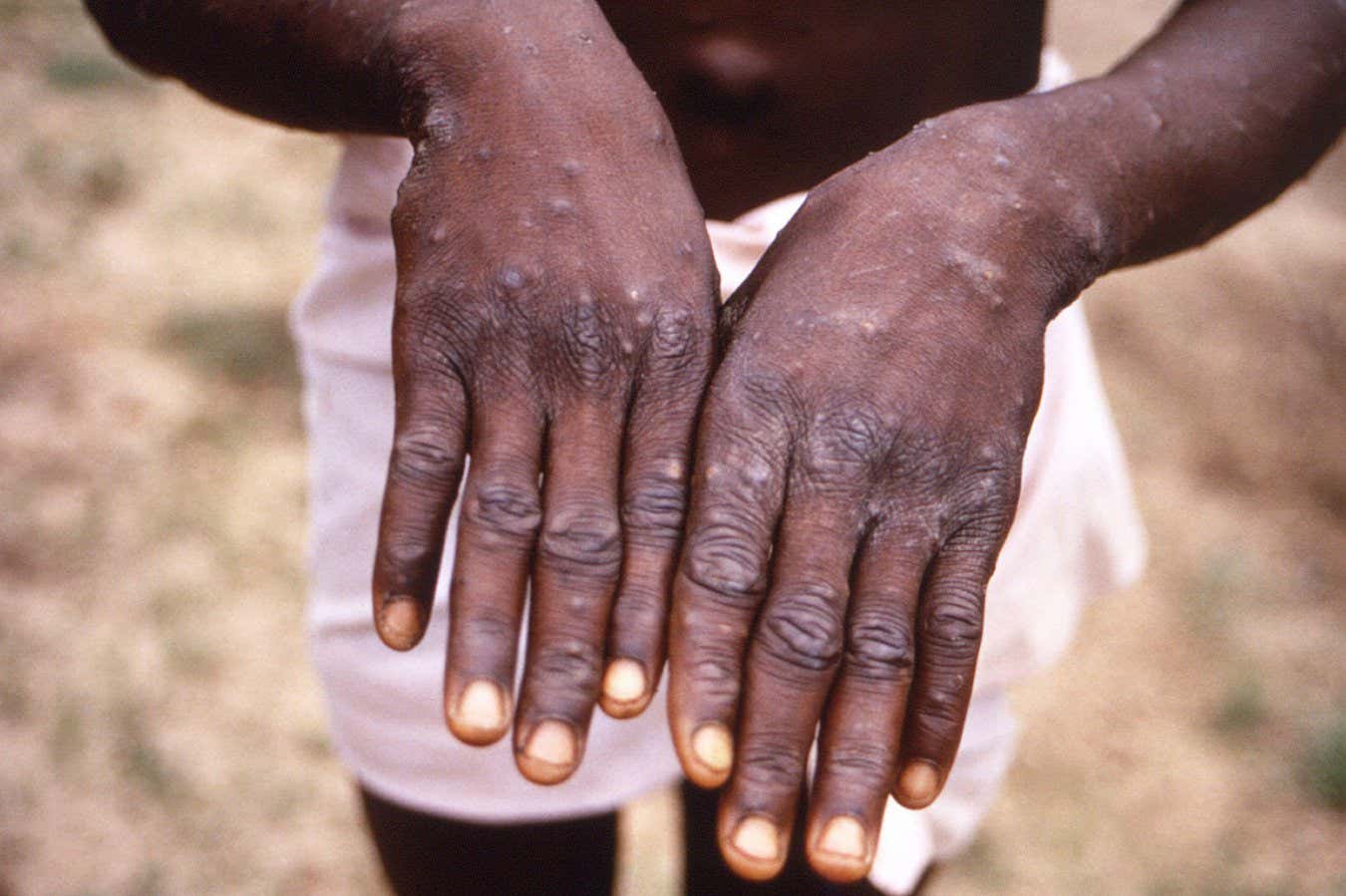 Does mpox cause lingering symptoms like long covid?